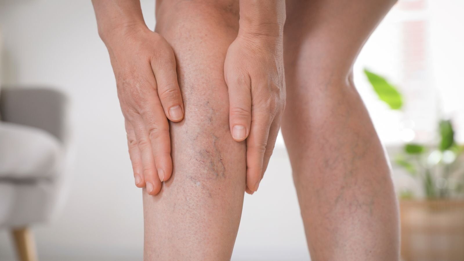 cura vene varicose flebologia sandrigo vicenza