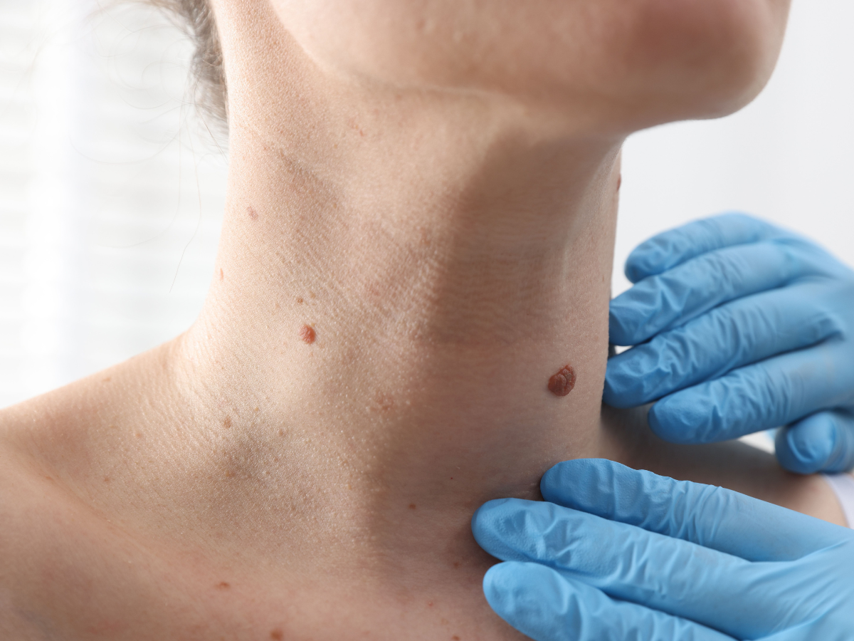 Visita dermatologica presso Poliambulatorio BluMedica a Sandrigo per pazienti di Vicenza, Dueville, Montecchio Precalcino e Thiene